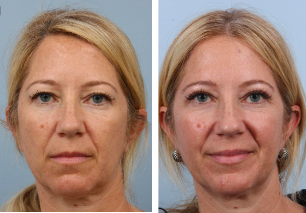 Before and After Blepharoplasty Dubai: Real Results and Patient Experiences