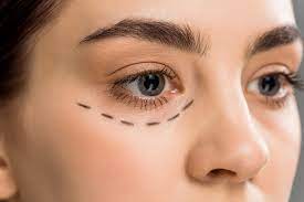 Eyelid Bag Surgery Dubai: Natural Rejuvenation Results