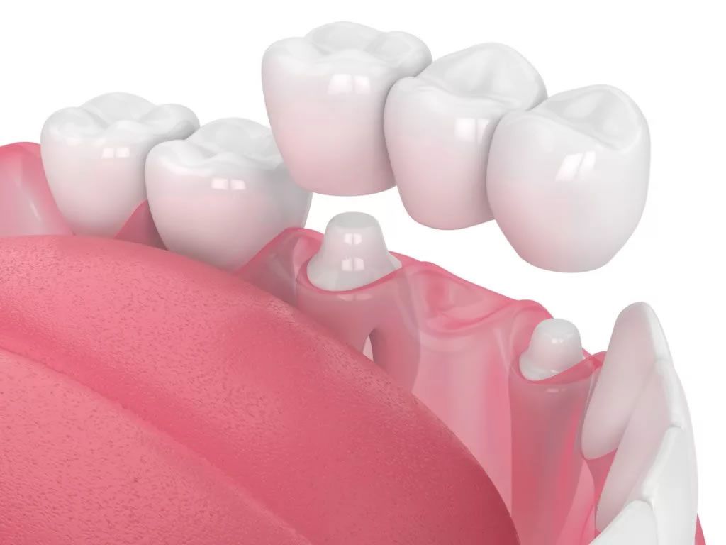 Benefits of Dental Crown Dubai for Damaged Teeth