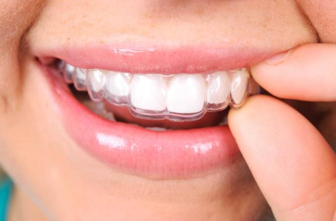 How to Maintain Your Aligners During Invisalign Dubai Treatment
