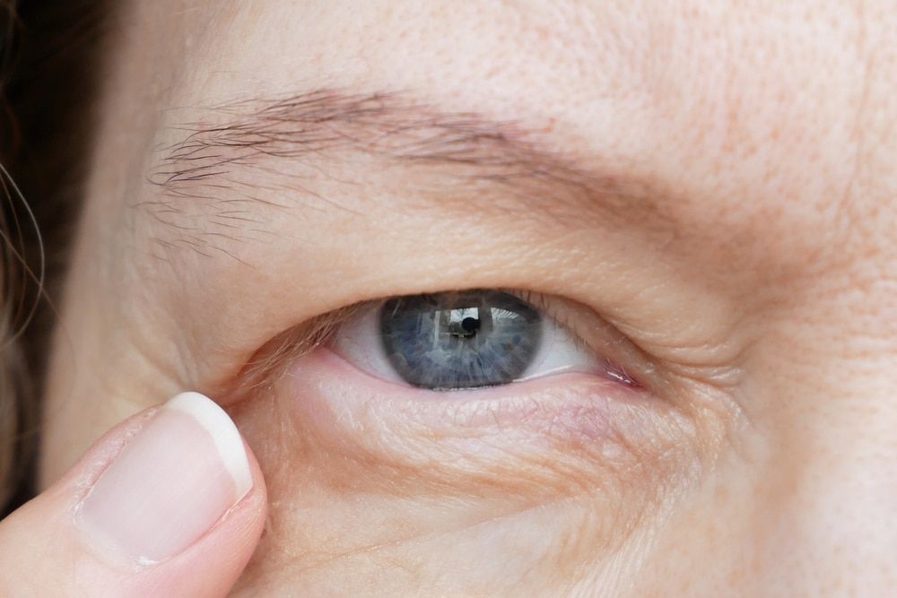 Eyelid Bag Surgery in Dubai: Procedure and Recovery