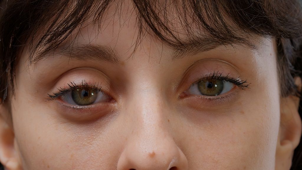 Eyelid Bag Surgery Dubai: Is Surgery Better Than Non-Surgical Treatments?